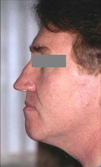 nose reshaping pre-op patient