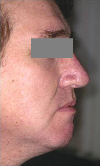 nose reshaping surgery patient, post op