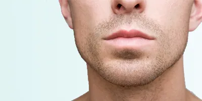 chin implants for men, genioplasty for men