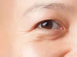 closeup image of woman's right eye with lower lid eye bags