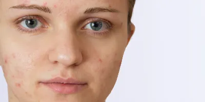 acne treatment, face acne treatment for men and women