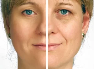 laser resurfacing female patient, before and after treatment photo
