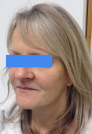 lateral brow lift and blepharoplasty procedure, female patient, post op