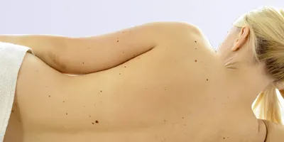 mole removal treatments