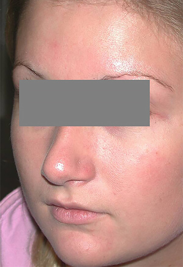 female rhinoplasty patient after surgery at Wentworth Clinic