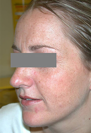 rhinoplasty surgery female, after surgery picture