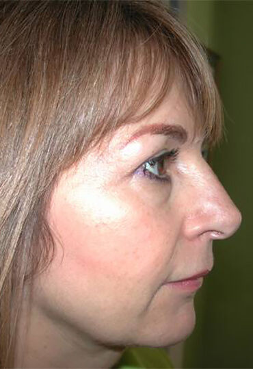 eyelid surgery female patient, post-op