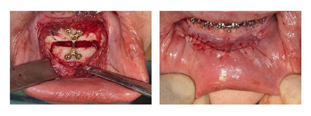 box genioplasty method