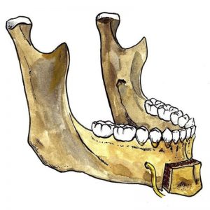 box genioplasty, mandible