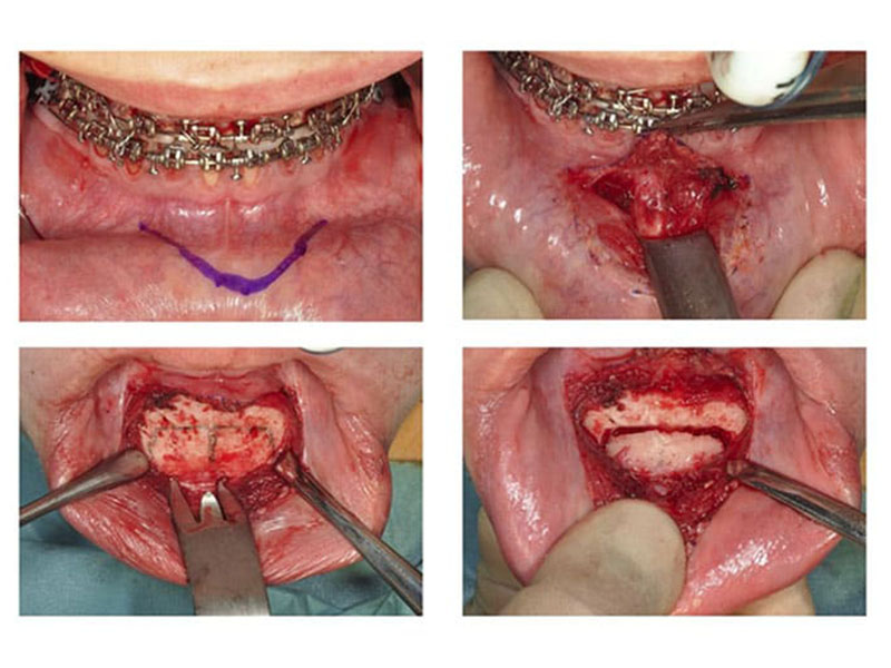 box genioplasty procedure