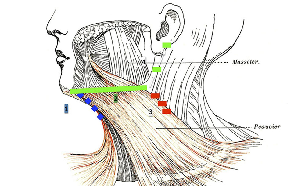 neck lift - muscles of the neck diagram