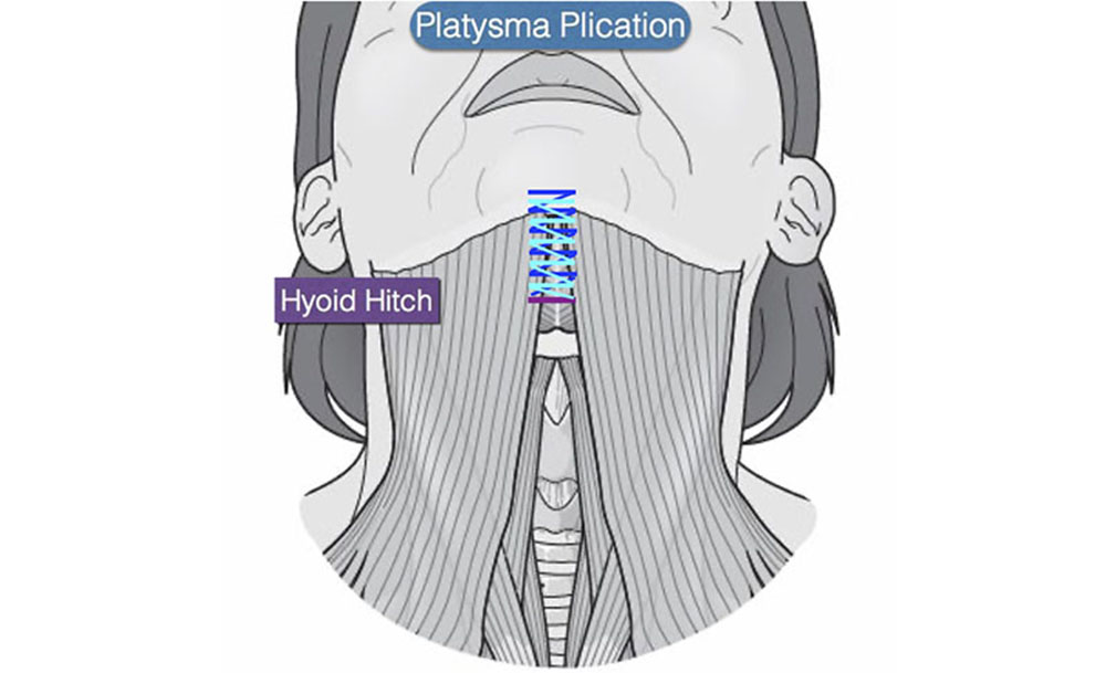 platysma plication neck lift surgery procedure