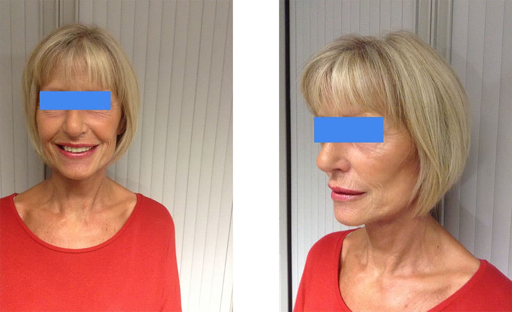 face/neck lift female client - post surgery images