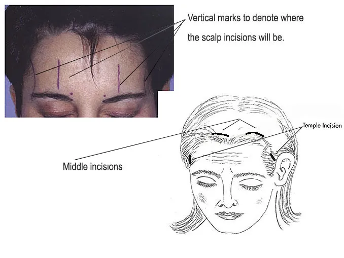 brow lift incision mark-up drawing