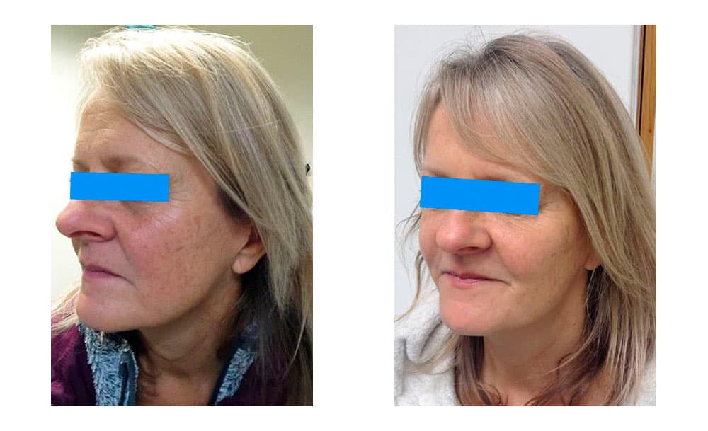 lateral brow lift female client pre and post surgery images