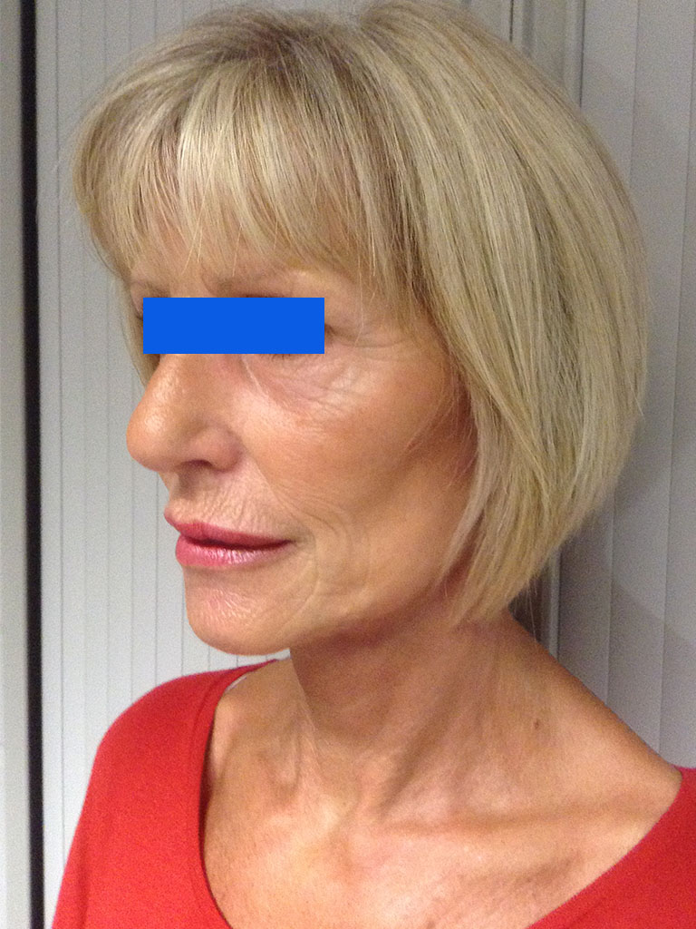 female patient following lower eyebag removal (lower blepharoplasty)