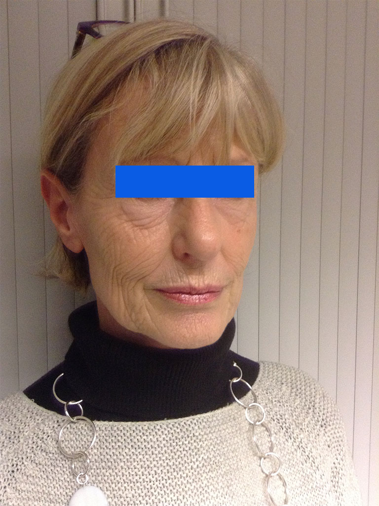 lower blepharoplasty female patient pre surgery