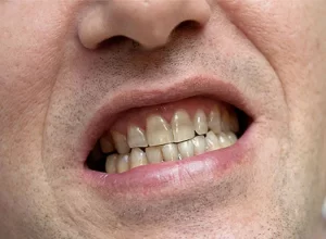 lower portion of male patients face with worn and discoloured teeth