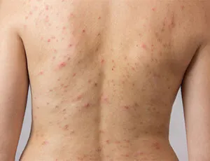 back acne treatments for men and women