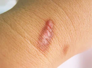 burn scar on female patient
