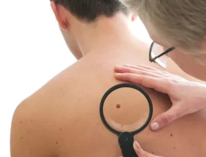 skin mole diagnosis and removal