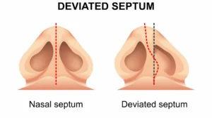 vector image of septum beside deviated septum