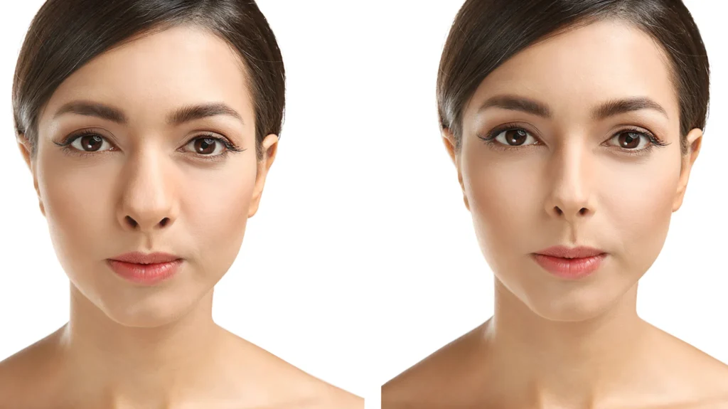 before and after rhinoplasty surgery - beautiful white, brown haired female patient