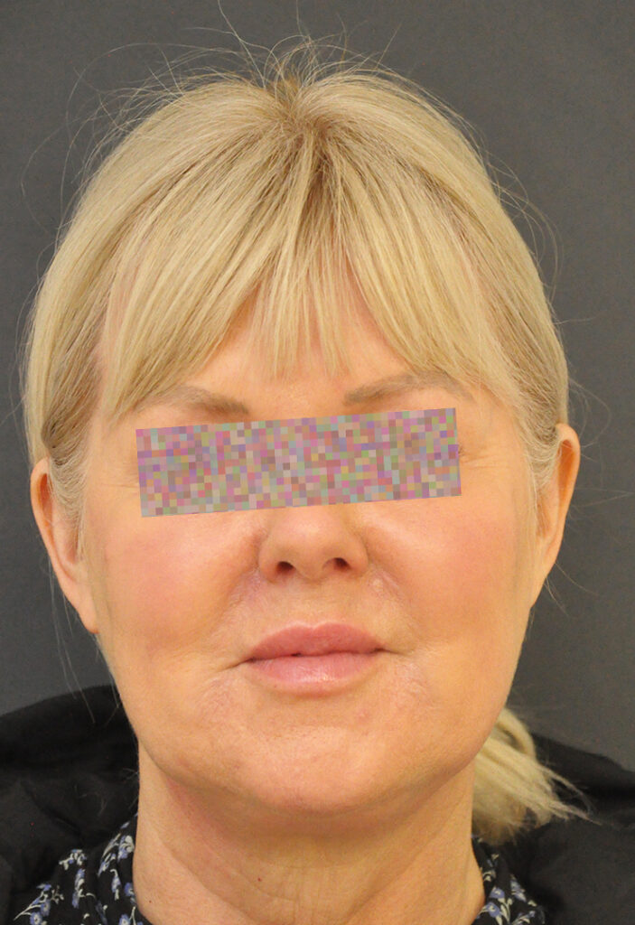 female patient pre op frontal view of face including neck
